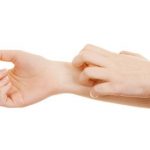 Dermatitis seborreica: causas y diferencias con la seborrea