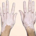 Vitiligo: Qué es, causas y tratamiento