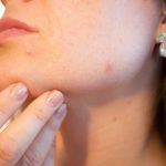 Aprendiendo sobre la dermatitis seborreica
