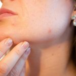 Tipos de acné y cómo combatirlo en la edad adulta