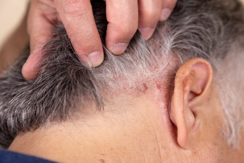 dermatitis seborreica, en el cuero cabelludo